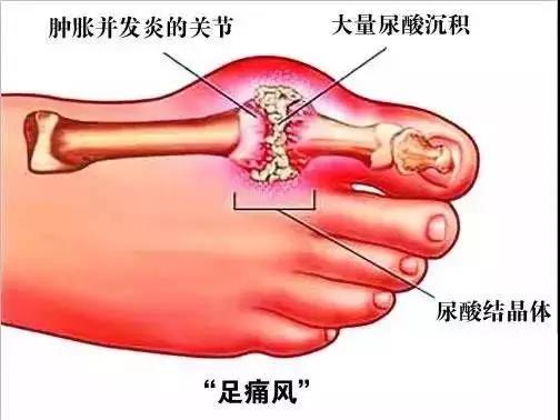 音樂療法如何預(yù)防尿酸高